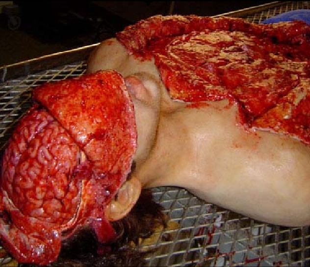 File:Makeup encephalectomy2.jpg