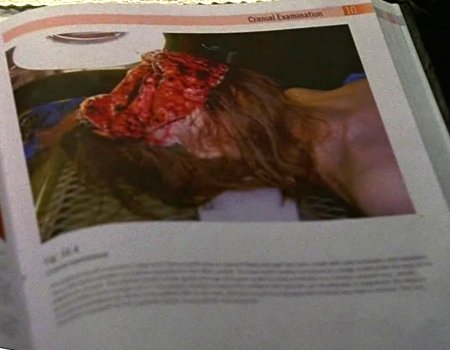 File:Encephalectomy Text.jpg