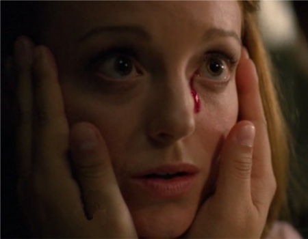 Fichier:Charlie's Aneurysm.jpg